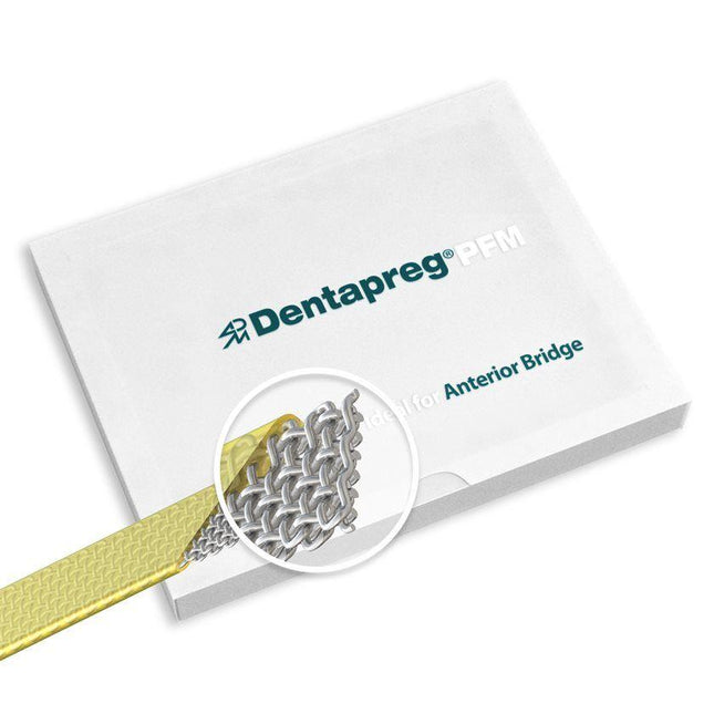 Dentapreg-kuitu PFM Anterior Bridge